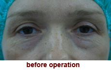 plastic-surgery-blepharoplasty